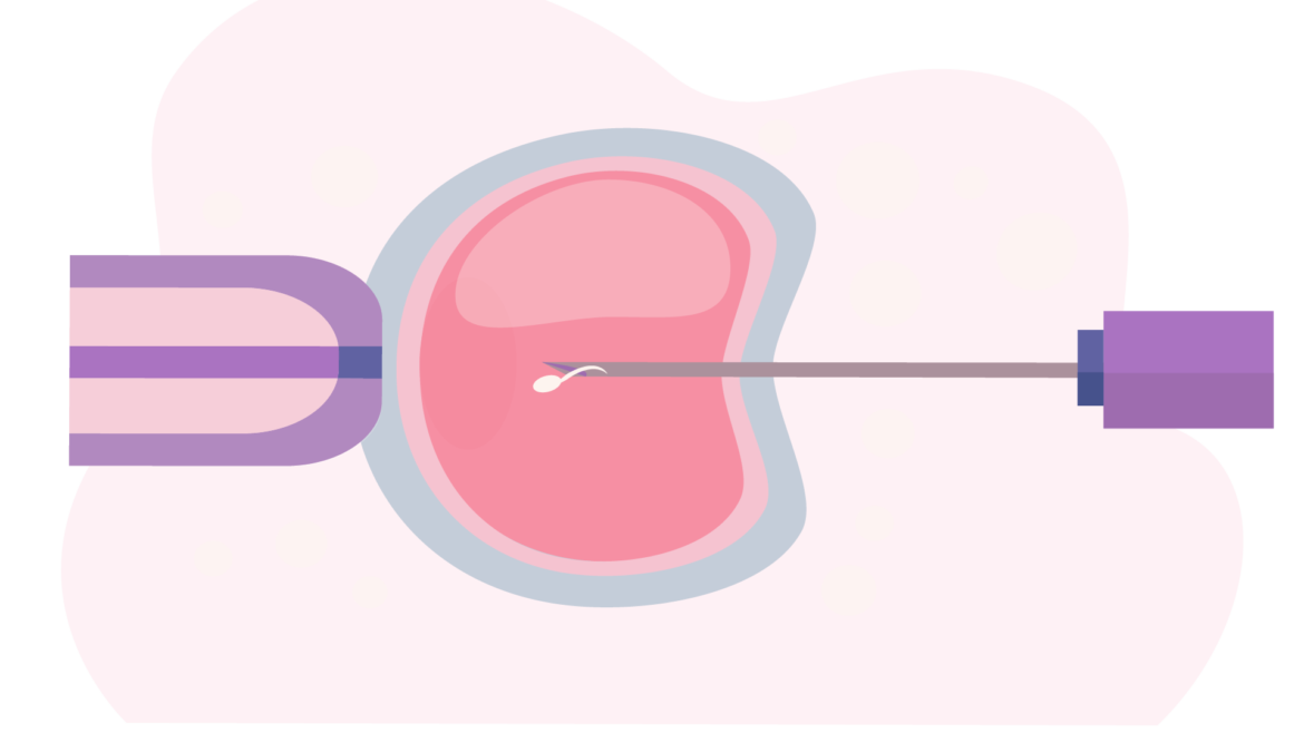 ICSI – Intracytoplasmic Sperm Injection