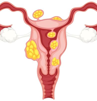 PCOS