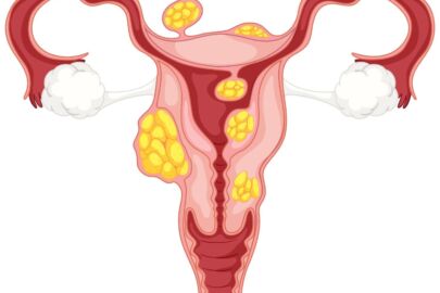 PCOS